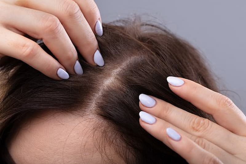 دلایل ریزش مو در خانم ها و راه های درمان