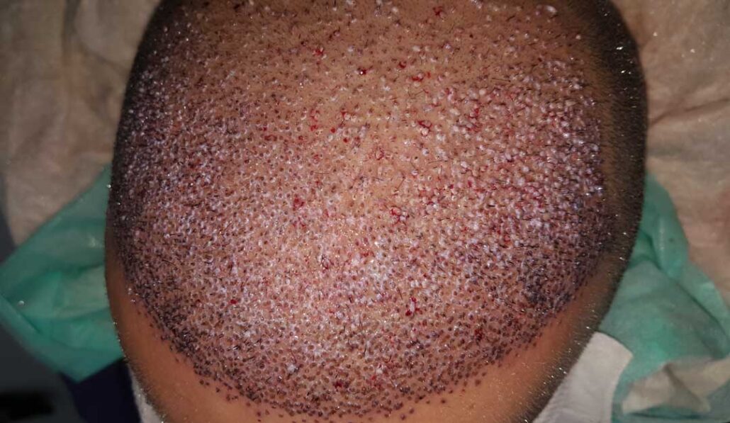 مراحل رشد موهای کاشته شده ، ریزش مو