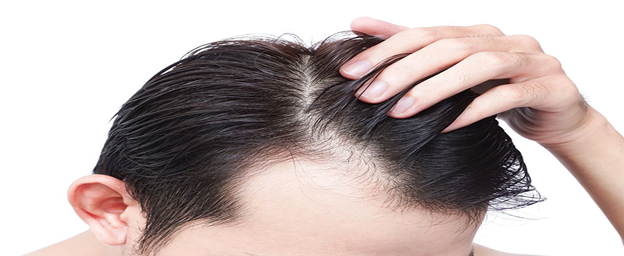 نقش تونیک palminex در جلوگیری از ریزش مو