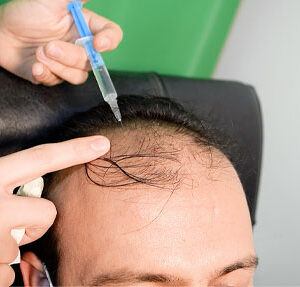 آموزش مزوتراپی مو