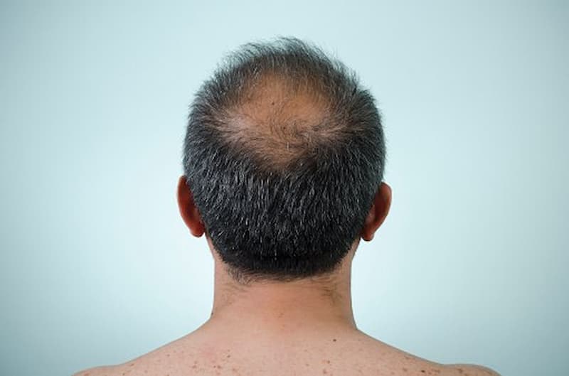 تاثیر ژنتیک در ریزش موی آقایان