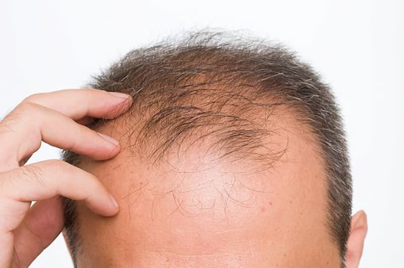 درمان ریزش مو در اقایان