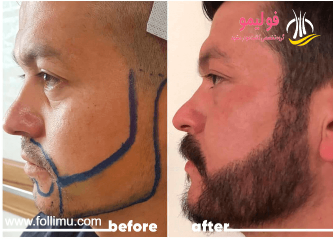 کاشت مو و ریش