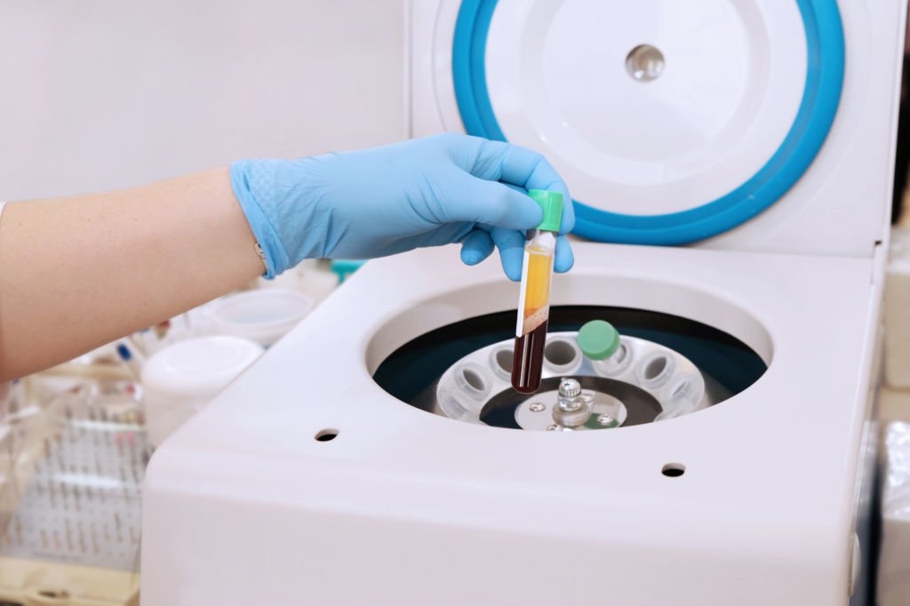 هزینه روش PRP چقدر است؟