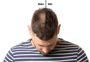 استفاده از قرص یا آمپول بیوتین
