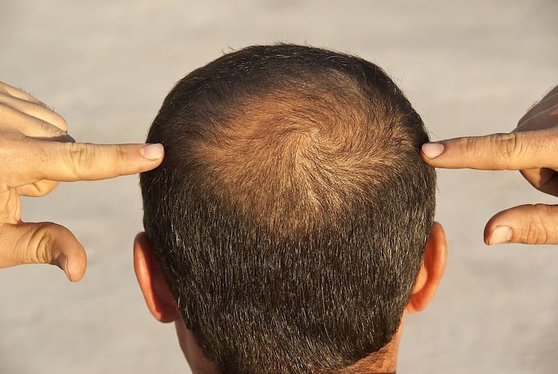  ریزش ناگهانی مو در مردان و زنان