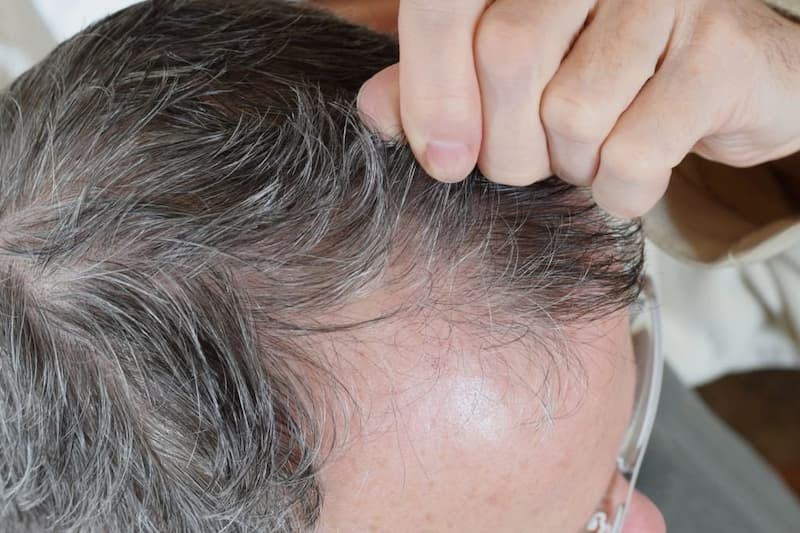 بیماری های عفونی نیز می تواند منجر به ریزش مو ها شود