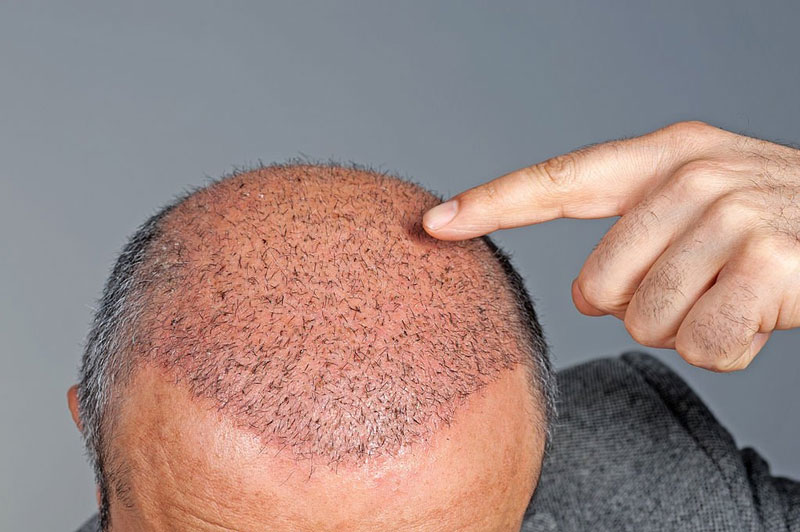 شرایط استفاده از کلاه بعد از کاشت مو