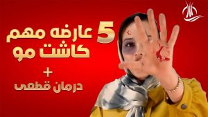 عوارض کاشت مو