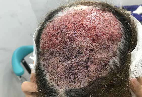 آزردگی و کبودی های بعد از عمل کاشت مو