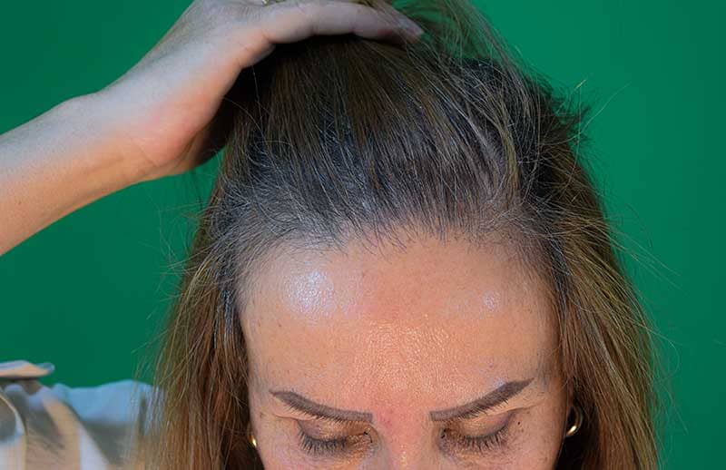 استرس ابتلا به کرونا یکی از عوامل اصلی ریزش مو در آن دوره است.