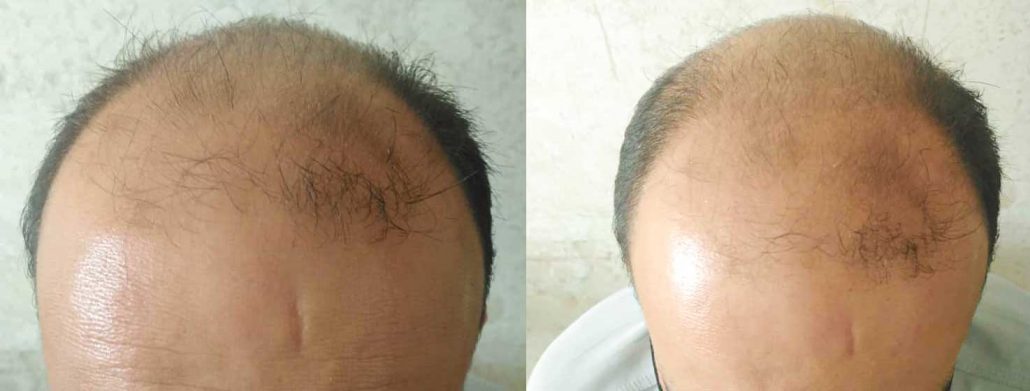 نمونه موی سر قبل از کاشت مو