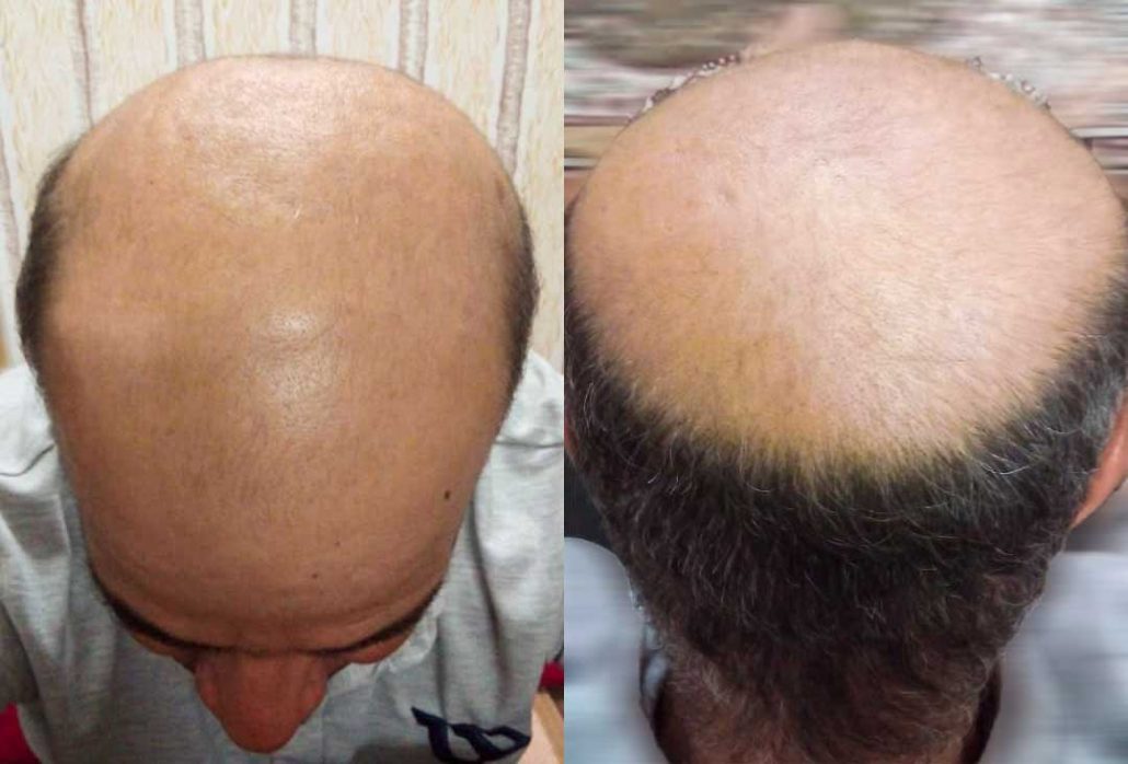 انجام آزمایش و بررسی وضعیت ظاهری موی سر از روی عکس فرستاده شده