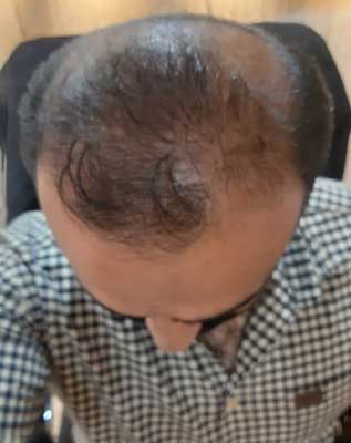 قبل از کاشت