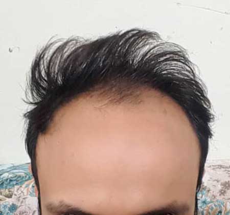 قبل از کاشت مو ، کاشت مو
