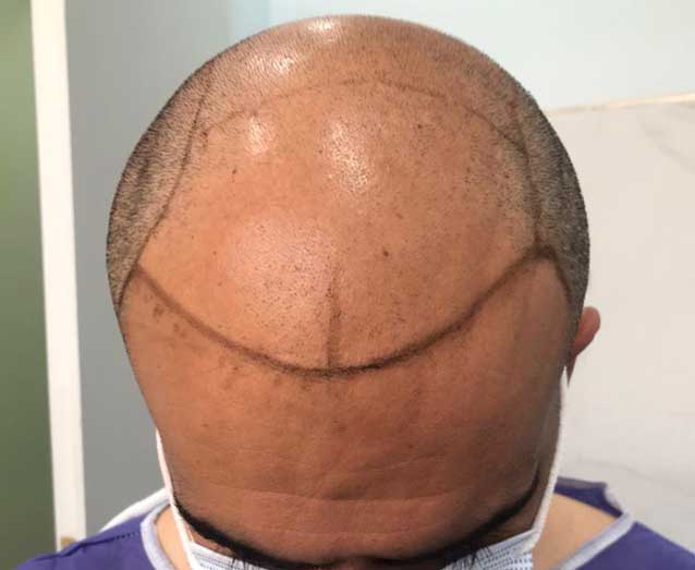 خط رویش ، کاشت مو