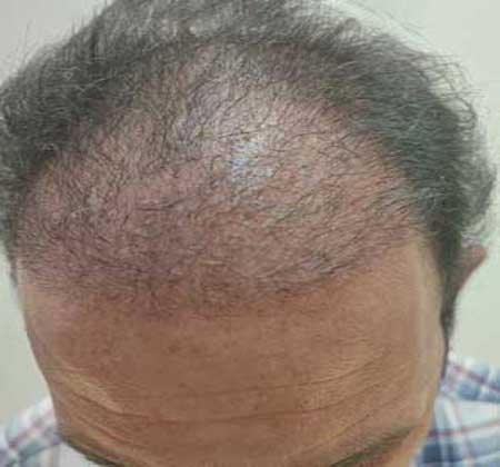 کاشت با تراکم بالا