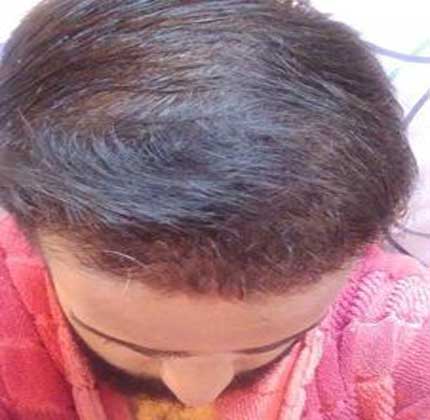 نتیجه نهایی کاشت مو، نمونه کاشت مو طبیعی