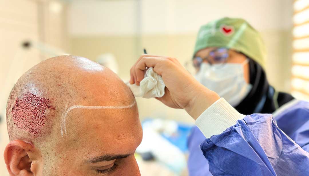 کاشت مو به روش Fit روی سر یک آقا توسط دکتر کاشت مو