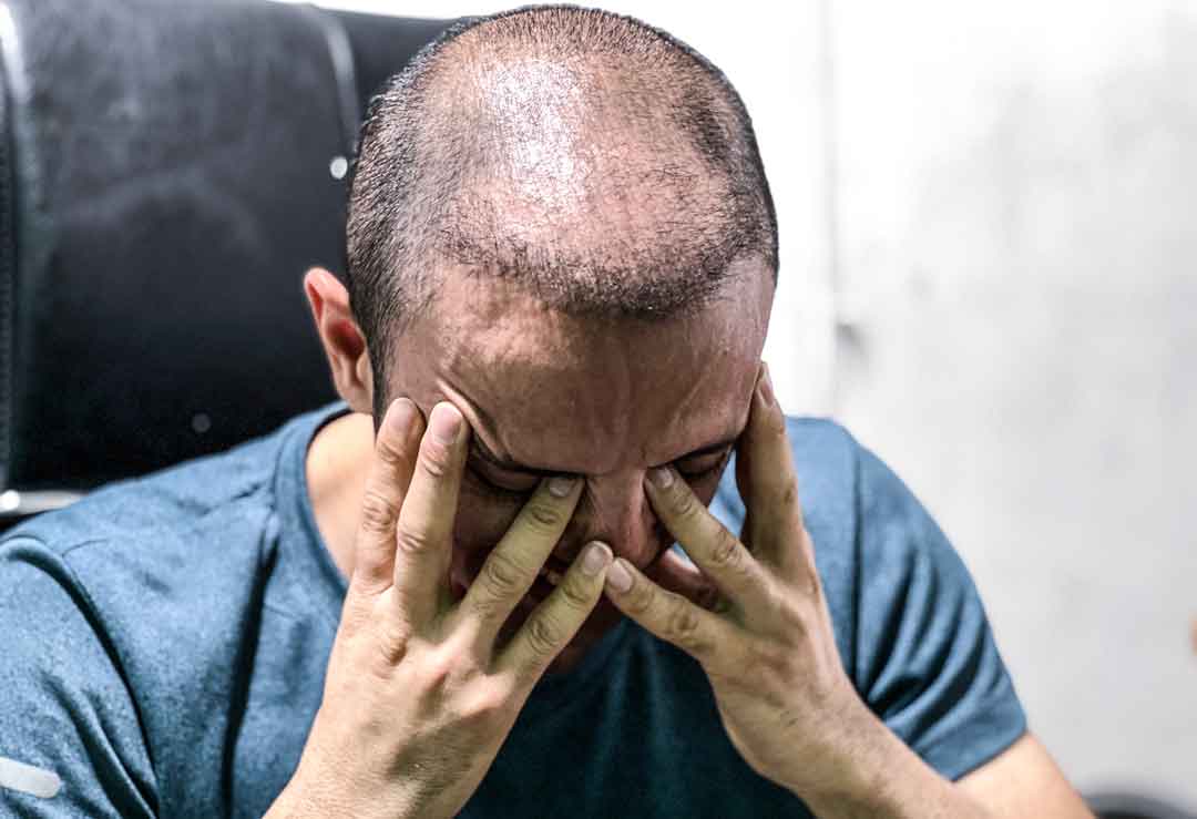 رابطه استرس و افسردگی با ریزش مو