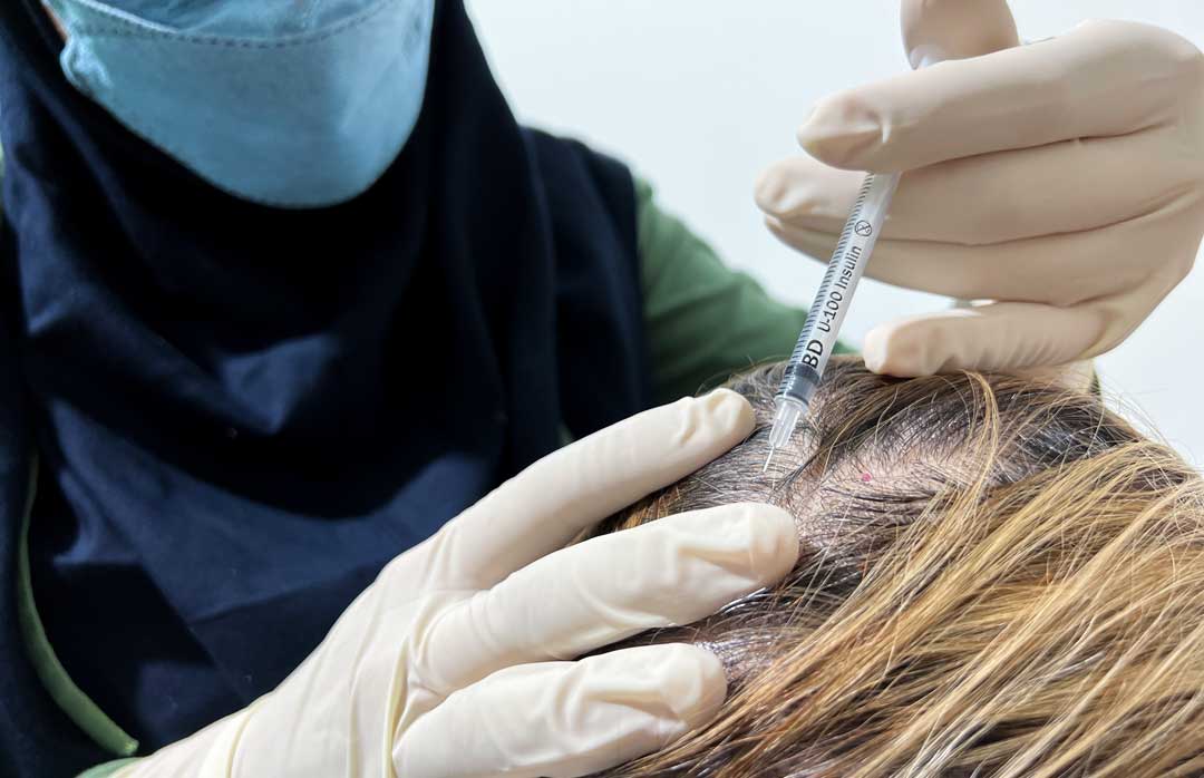 هزینه مزوتراپی مو سر