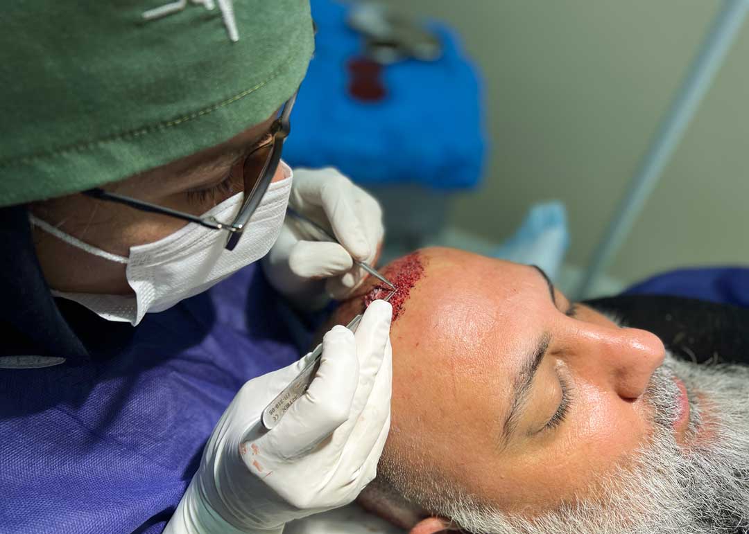 کاشت مو به روش fit  روی سر یک آقا توسط دکتر متخصص کاشت مو