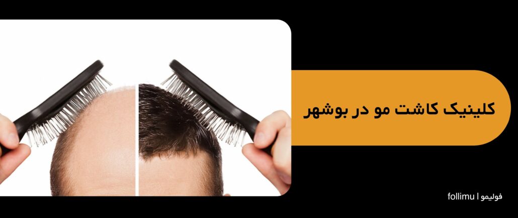 بهترین کلینیک کاشت مو دربوشهر