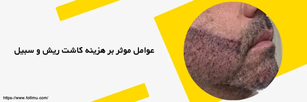 تصویر کاشت ریش توسط خانم بیانی