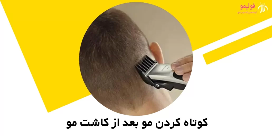 تصویر مربوط به کوتاه کردن مو بعد از کاشت است.