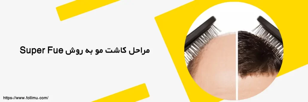 تصویر نتیجه کاشت مو به روش Super Fue توسط خانم دکتر بیانی