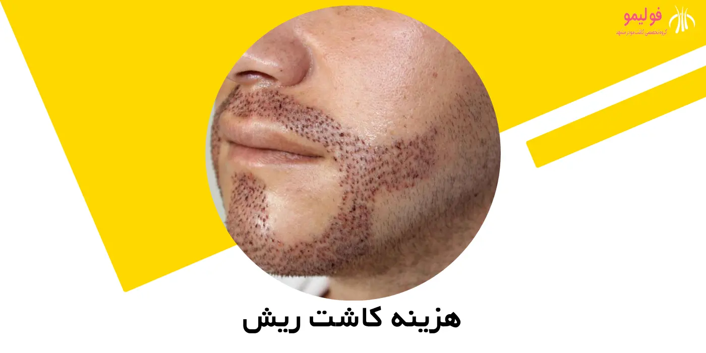 هزینه کاشت ریش در مشهد