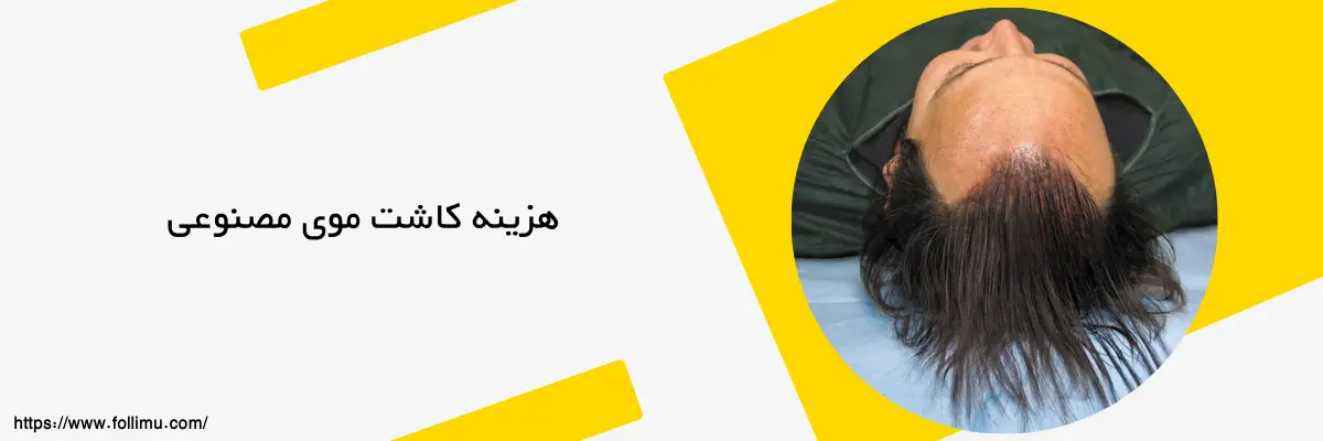 قیمت کاشت مو مصنوعی چقدر است؟