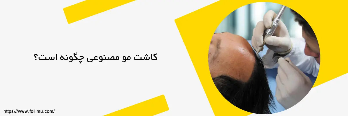 کاشت موی مصنوعی چگونه انجام می شود؟