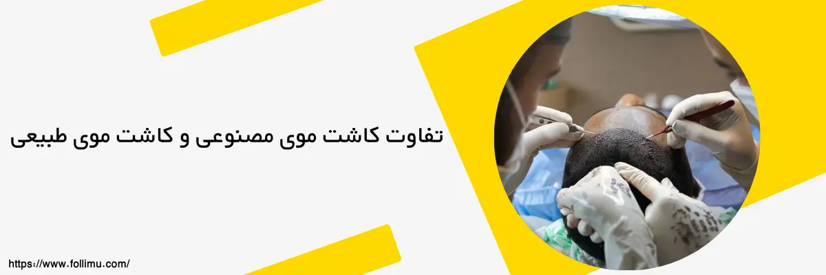 مهم‌ترین تفاوت های کاشت مو مصنوعی در برابر کاشت طبیعی